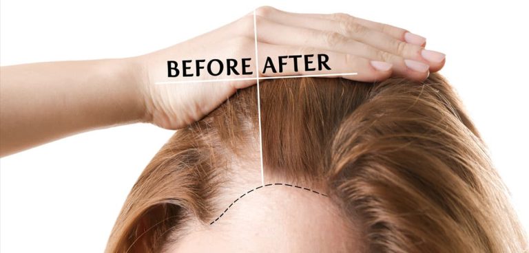 Choosing The Right Surgeon For Crown Hair Transplants